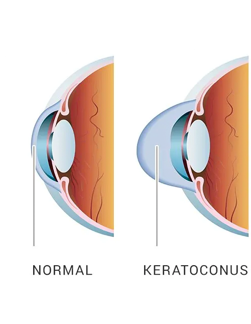 Keratoconus Management