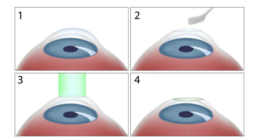 TransPRK Laser Correction